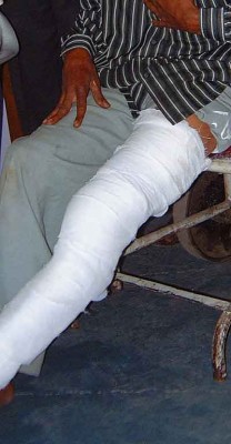 Broken leg